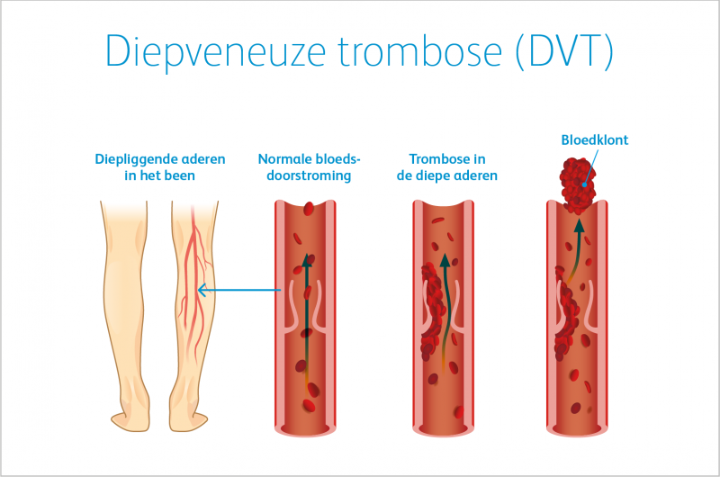 Wat is tromboseprofylaxe? | Pfizer Nederland